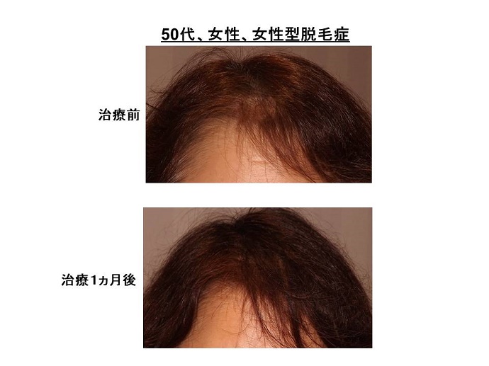 円形脱毛症　病院""